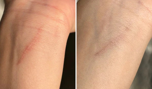 Luviva - Avanceret Silikonetape til Arbehandling og Rynker