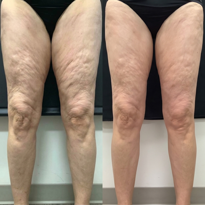 VelvetFirm – Åtstramande Kroppskräm med Retinol, Hyaluronsyra, Ceramider och Plant Squalane
