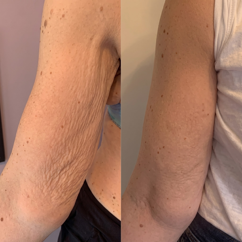 VelvetFirm – Åtstramande Kroppskräm med Retinol, Hyaluronsyra, Ceramider och Plant Squalane